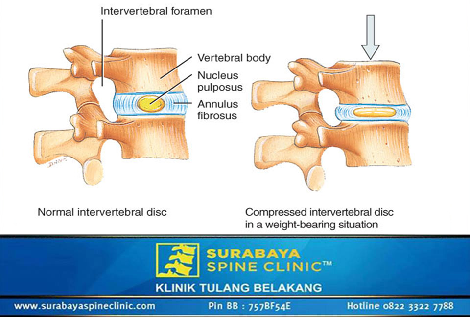 HNP, Saraf Terjepit Pada Tulang Belakang 