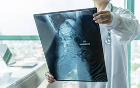 Tentang Ankylosing Spondylitis