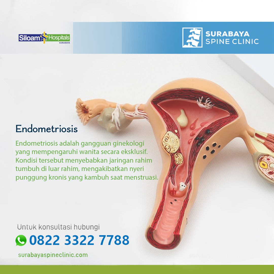 Endometriosis, Penyebab Nyeri Punggung Wanita yang Jarang Diketahui