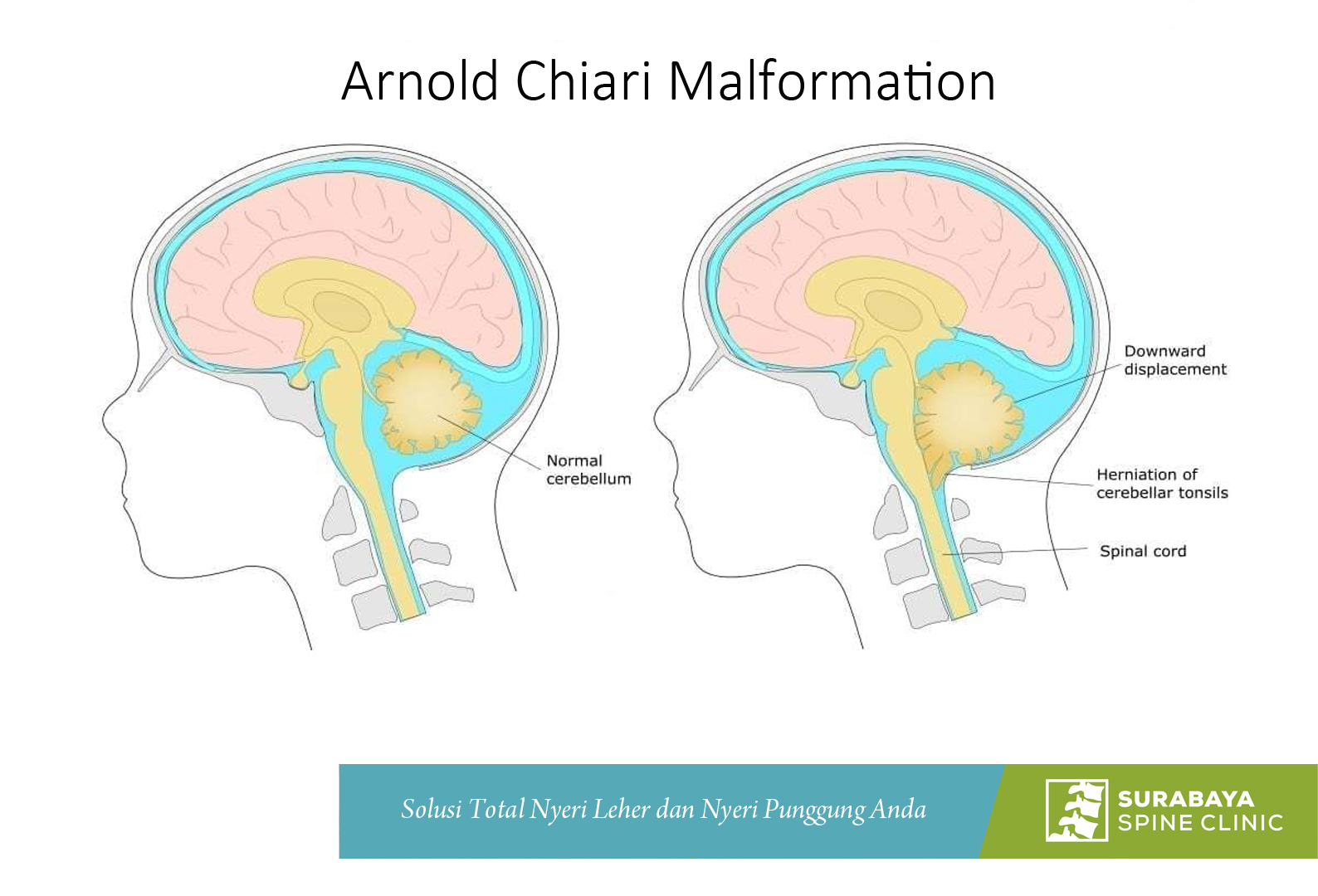 Chiari Malformasi, Nyeri Bawah Kepala