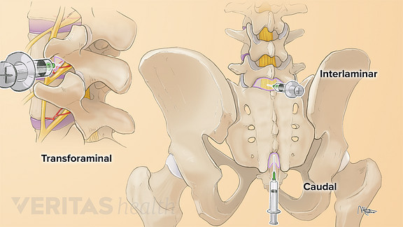 Injeksi / Suntikan Steroid pada Epidural 