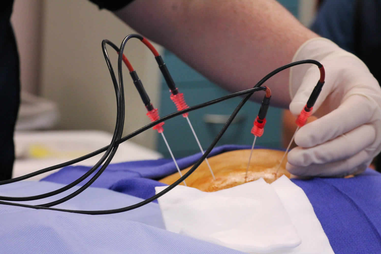 Radiofrequency Ablation untuk Nyeri Punggung/Leher Ringan