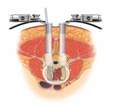 Minimally Invasive Neurosurgery