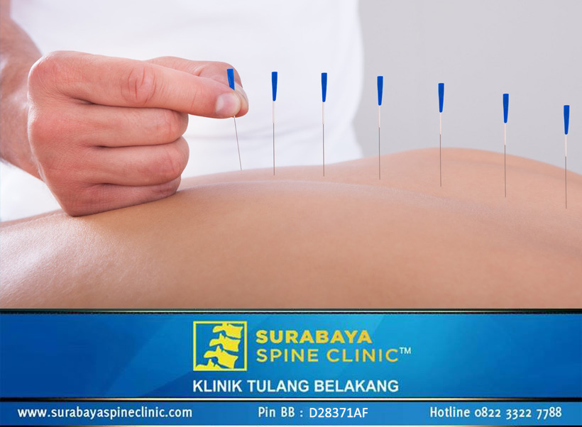 Akupuntur, Pilihan Terapi Alternatif Pereda Nyeri untuk Saraf Terjepit